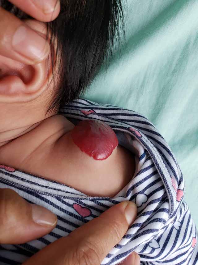 Bebe con hemangioma en el hombro