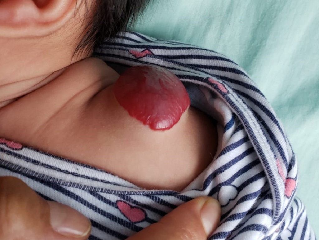 Bebe con hemangioma en hombro